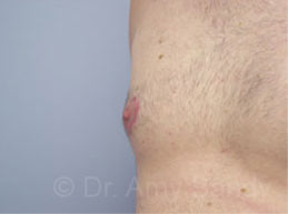 Gynecomastia Before & After Patient #7543