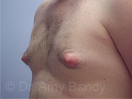 Gynecomastia Before & After Patient #7543