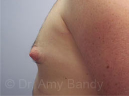 Gynecomastia Before & After Patient #7543