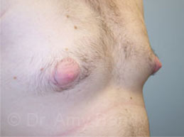 Gynecomastia Before & After Patient #7543