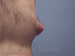 Gynecomastia Before & After Patient #7543
