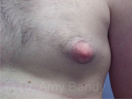 Gynecomastia Before & After Patient #7543
