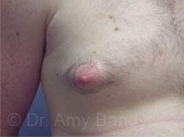 Gynecomastia Before & After Patient #7543