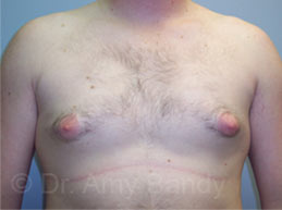 Gynecomastia Before & After Patient #7543
