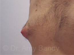 Gynecomastia Before & After Patient #7543