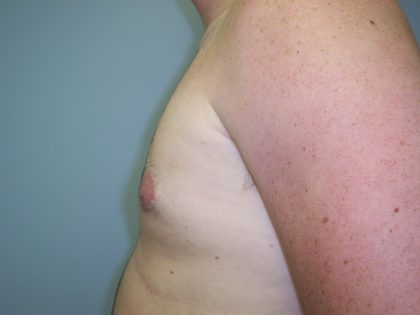 Gynecomastia Before & After Patient #7470