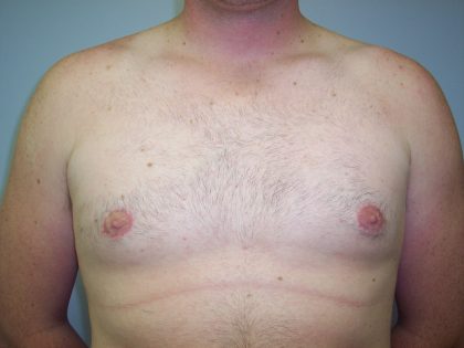 Gynecomastia Before & After Patient #7470