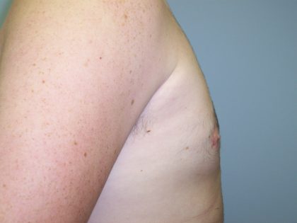 Gynecomastia Before & After Patient #7470