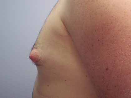 Gynecomastia Before & After Patient #7470