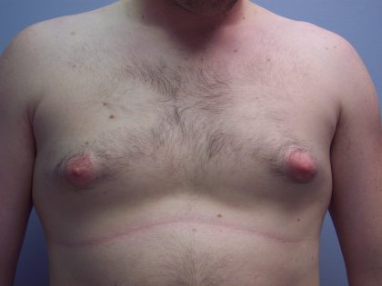 Gynecomastia Before & After Patient #7470