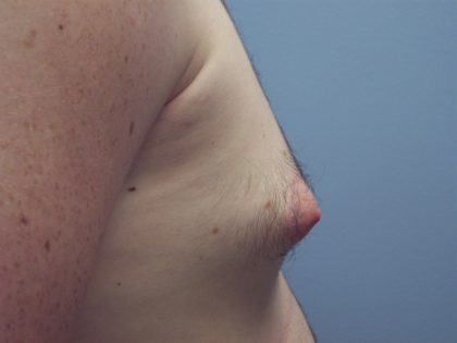 Gynecomastia Before & After Patient #7470