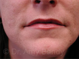 Lip Augmentation Before & After Patient #7981