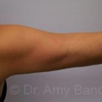 Liposuction Before & After Patient #9841
