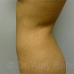 Liposuction Before & After Patient #9840