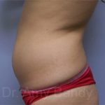 Liposuction Before & After Patient #9840