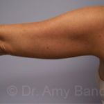 Liposuction Before & After Patient #9806