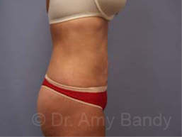 Liposuction Before & After Patient #9795