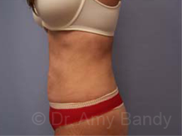 Liposuction Before & After Patient #9795