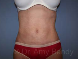 Liposuction Before & After Patient #9795