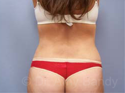 Liposuction Before & After Patient #9795
