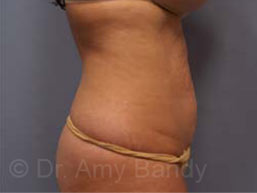 Liposuction Before & After Patient #9795