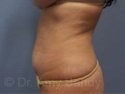 Liposuction Before & After Patient #9795