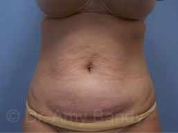 Liposuction Before & After Patient #9795