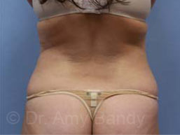 Liposuction Before & After Patient #9795