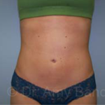 Liposuction Before & After Patient #9790