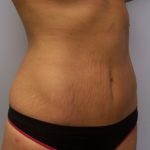 Liposuction Before & After Patient #9778