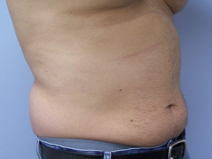 Liposuction Before & After Patient #9652