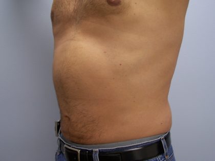 Liposuction Before & After Patient #9652