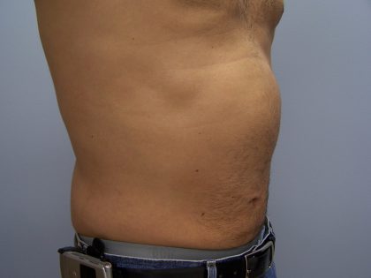 Liposuction Before & After Patient #9652