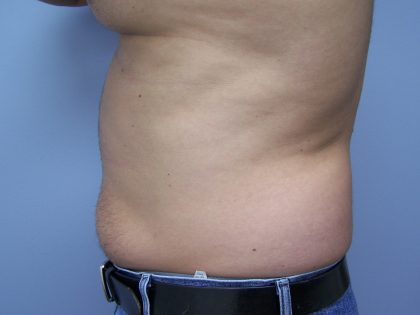 Liposuction Before & After Patient #9652