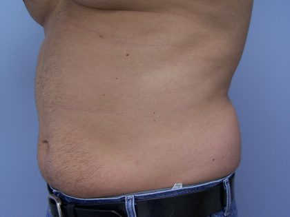 Liposuction Before & After Patient #9652