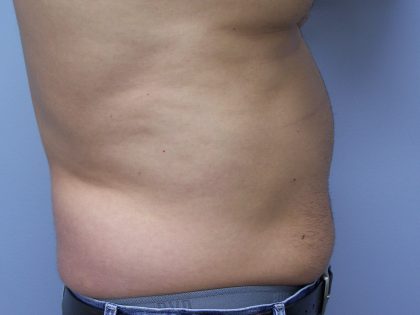 Liposuction Before & After Patient #9652