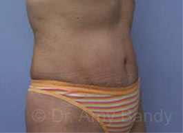 Tummy Tuck Before & After Patient #10071
