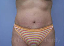 Tummy Tuck Before & After Patient #10071