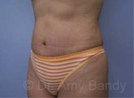 Tummy Tuck Before & After Patient #10071