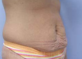Tummy Tuck Before & After Patient #10071