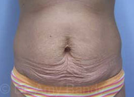 Tummy Tuck Before & After Patient #10071