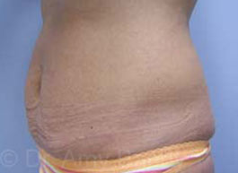 Tummy Tuck Before & After Patient #10071
