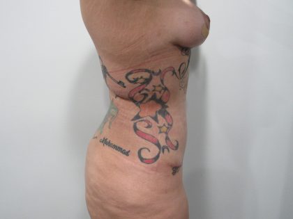 Tummy Tuck Before & After Patient #9988