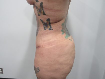 Tummy Tuck Before & After Patient #9988